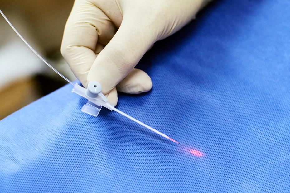 Odstránenie kŕčových žíl laserom